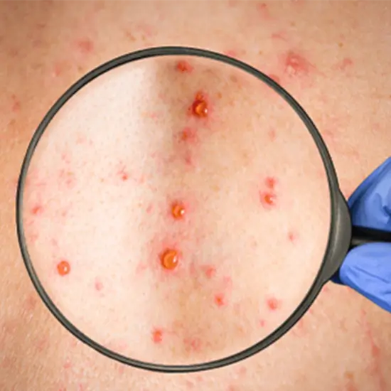 rubella german measles avidity igm test